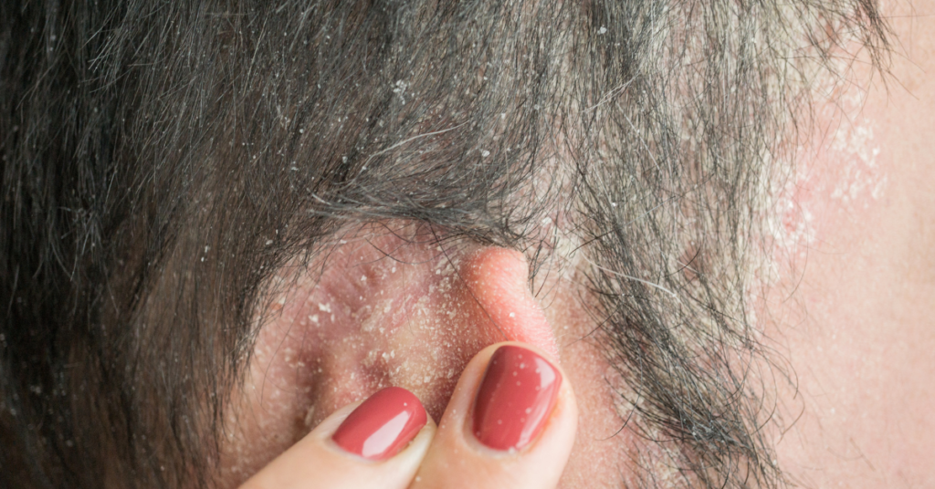 Discover the potential relief with 'Hydrogen Peroxide on Scalp Psoriasis.' An image showcasing the transformative benefits for a healthier, itch-free scalp.