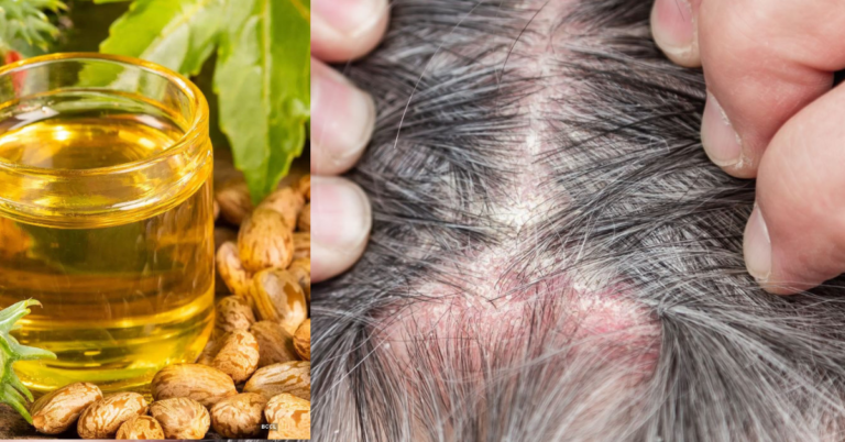 Close-up view of a bottle of castor oil, a natural remedy for psoriasis scalp treatment. The rich, golden oil is known for its soothing and moisturizing properties, offering potential relief from redness and discomfort associated with psoriasis on the scalp.