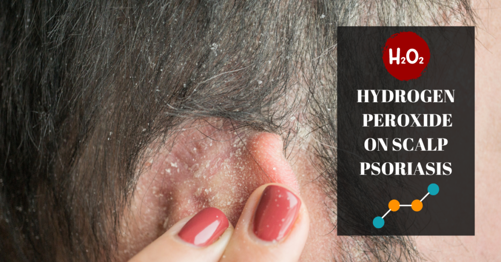 Hydrogen Peroxide on Scalp Psoriasis - Discover relief with this transformative image showcasing the potential of hydrogen peroxide for a healthier, itch-free scalp.